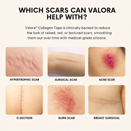 Valora Silicone Collagen Patches