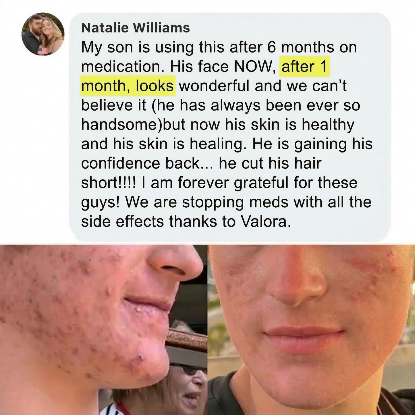 12% Azelaic Acid Cream  - Acne & Redness Support