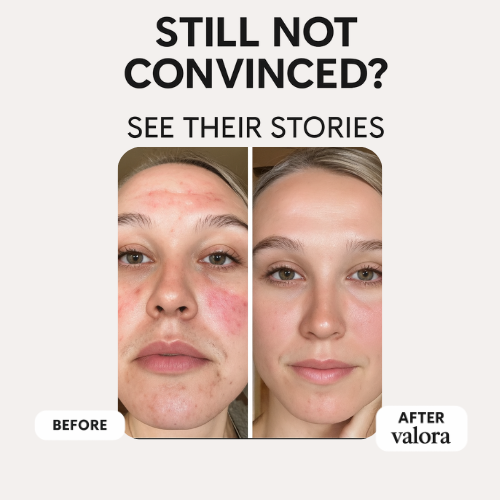 Valora Liquid-Microneedling Exosome