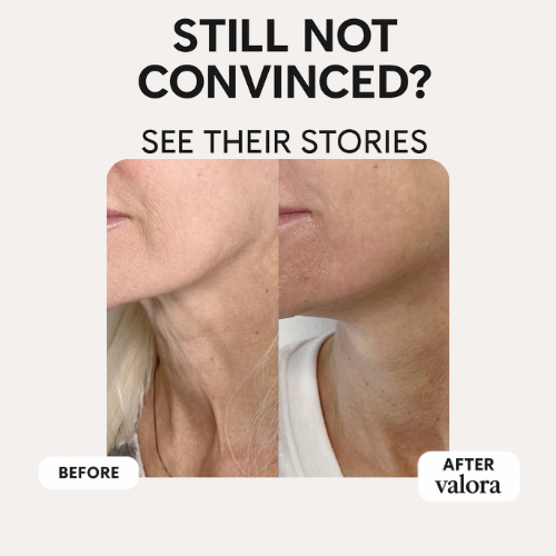 Valora Liquid-Microneedling Exosome