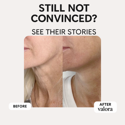 Valora Liquid-Microneedling Exosome
