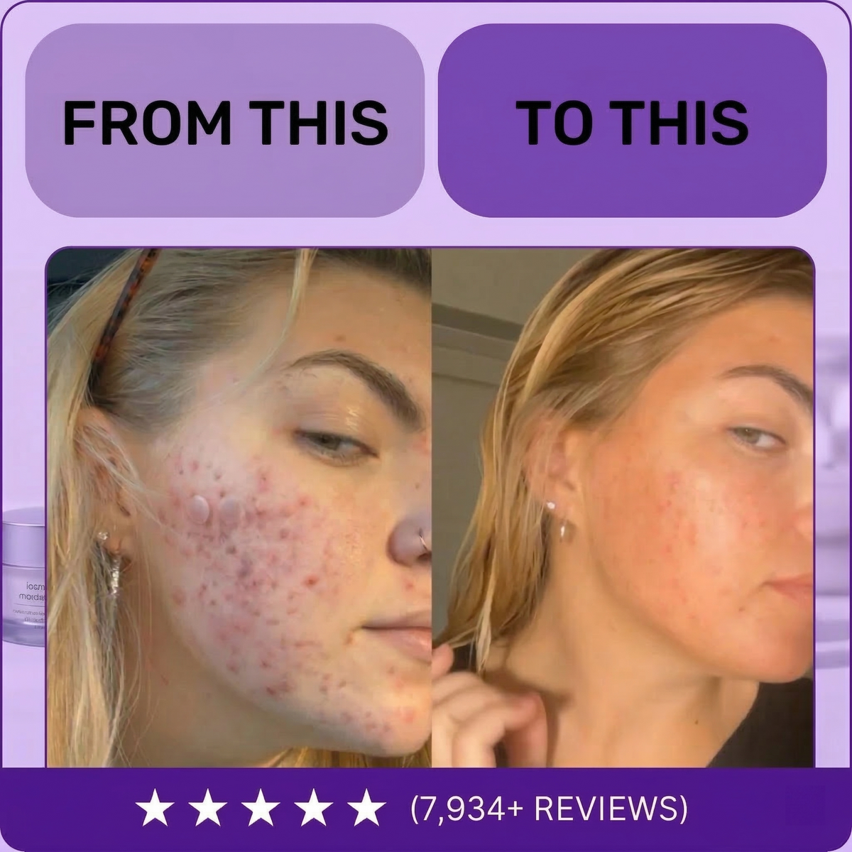 12% Azelaic Acid Cream - Acne & Redness Support – Valora